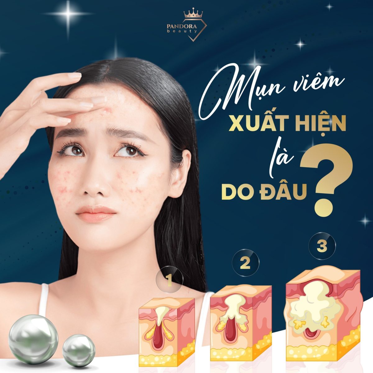 Mụn viêm: Kẻ thù thầm lặng số 1!