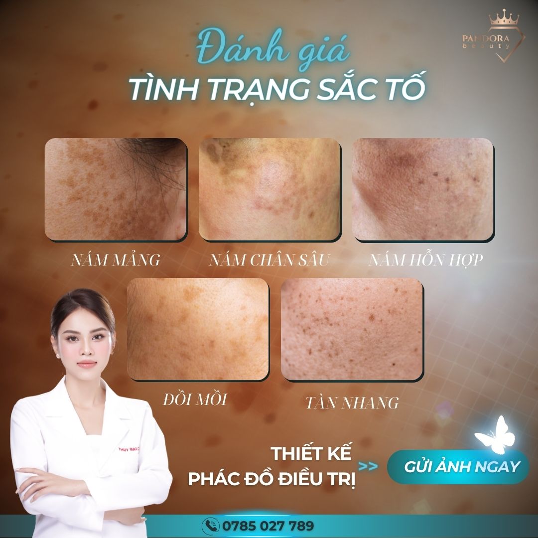 Điều Trị Nám, Tàn Nhang và Hắc Sắc Tố: Hướng Dẫn Toàn Diện Để Đạt Hiệu Quả Tối Ưu