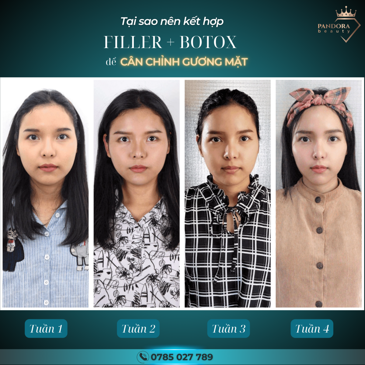 Liệu Trình Kết Hợp Botox Filler Hoàn Hảo