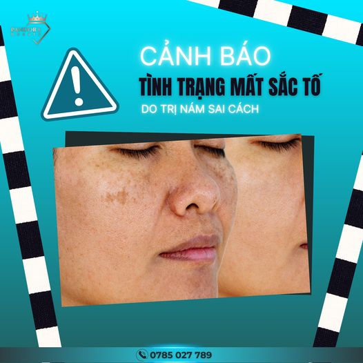 Nám da và Mất sắc tố da sau laser: Nguy cơ tiềm ẩn và giải pháp điều trị hiệu quả