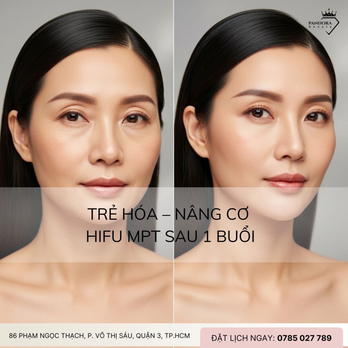 Review thực tế: Trẻ hóa – Nâng cơ HIFU MPT sau 1 buổi