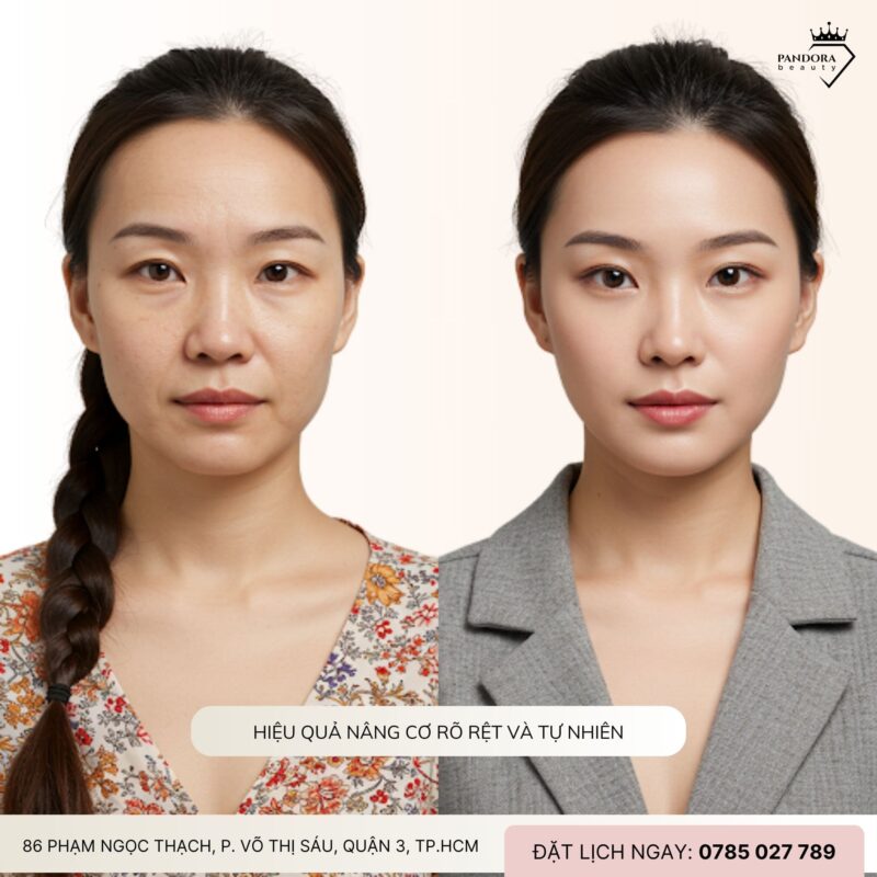 Tại sao nâng cơ HIFU MPT là xu hướng trẻ hóa năm 2025?