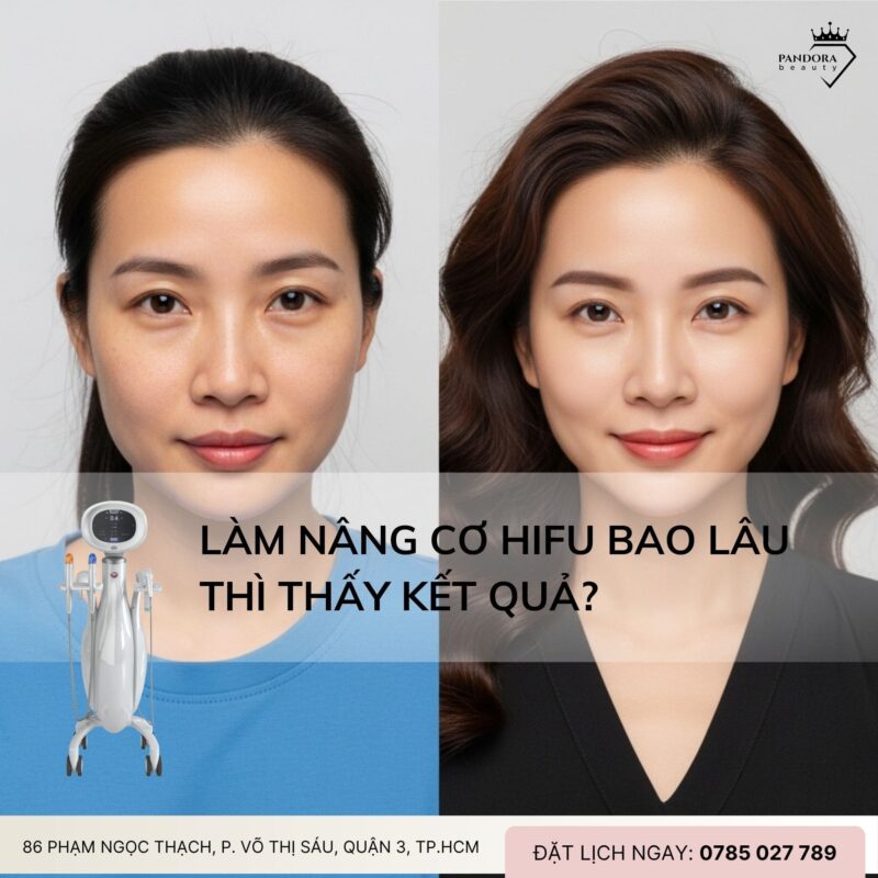Làm nâng cơ HIFU Bao Lâu Thì Thấy Kết Quả?