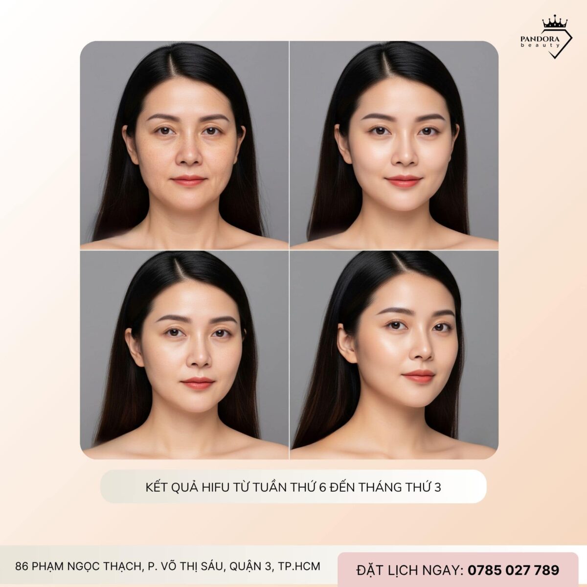 Làm nâng cơ HIFU Bao Lâu Thì Thấy Kết Quả?