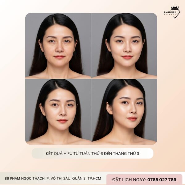 Làm nâng cơ HIFU Bao Lâu Thì Thấy Kết Quả?