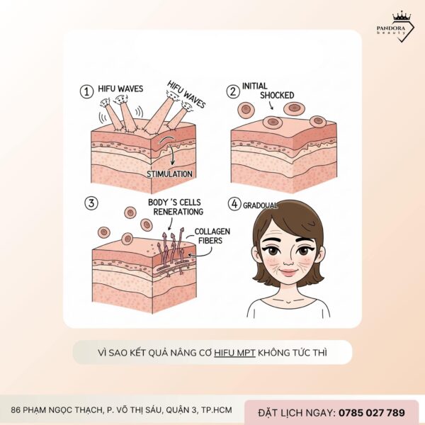 Làm nâng cơ HIFU Bao Lâu Thì Thấy Kết Quả?