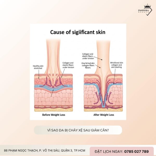 Giải pháp nâng cơ HIFU MPT cho da sau giảm cân, chảy xệ