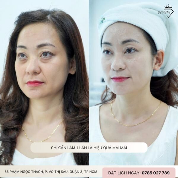 3 HIỂU LẦM PHỔ BIẾN VỀ NÂNG CƠ HIFU MPT – ĐỪNG ĐỂ MẤT CƠ HỘI LÀM ĐẸP VÌ NHỮNG NGỘ NHẬN!