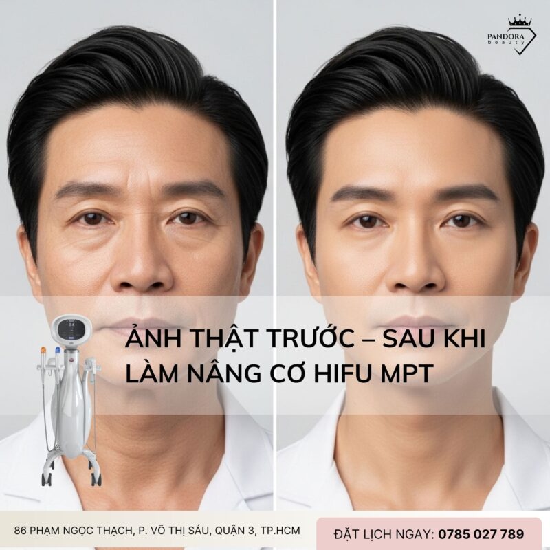 Ảnh Thật Trước – Sau Khi Làm Nâng Cơ HIFU MPT: Bí Mật Đằng Sau Làn Da Trẻ Trung Không Tuổi
