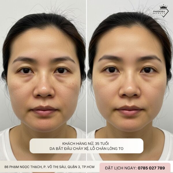 Ảnh Thật Trước – Sau Khi Làm Nâng Cơ HIFU MPT: Bí Mật Đằng Sau Làn Da Trẻ Trung Không Tuổi