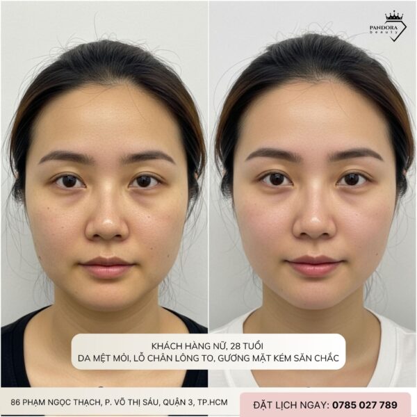 Ảnh Thật Trước – Sau Khi Làm Nâng Cơ HIFU MPT: Bí Mật Đằng Sau Làn Da Trẻ Trung Không Tuổi
