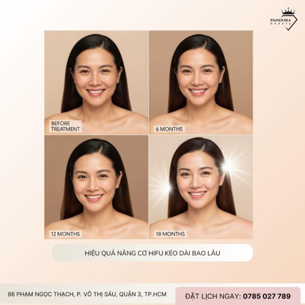 Có nên nâng cơ HIFU MPT định kỳ mỗi năm? Giải mã bí quyết giữ làn da trẻ trung không dao kéo