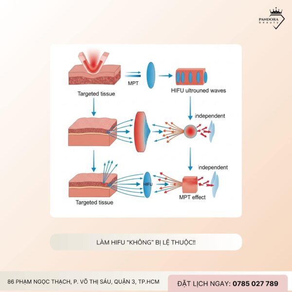 Làm Nâng cơ HIFU MPT có bị lệ thuộc không? Giải đáp từ chuyên gia thẩm mỹ