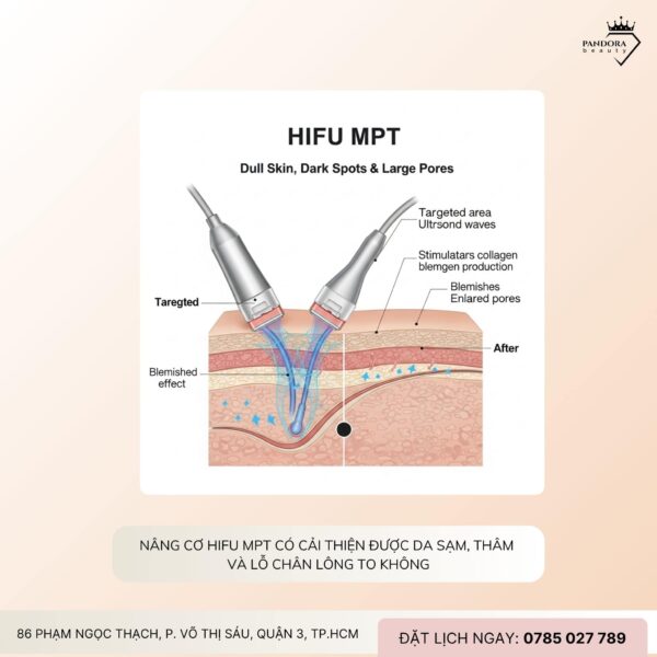 Nâng cơ HIFU MPT có cải thiện da sạm, lỗ chân lông to không?