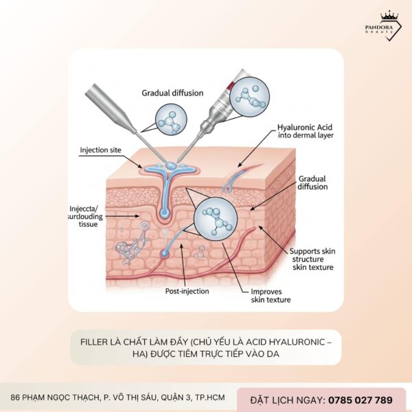 Nâng cơ HIFU MPT có thay thế tiêm filler không? Câu trả lời khiến bạn bất ngờ!