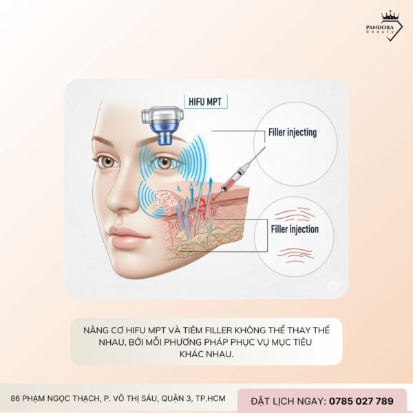 Nâng cơ HIFU MPT có thay thế tiêm filler không? Câu trả lời khiến bạn bất ngờ!