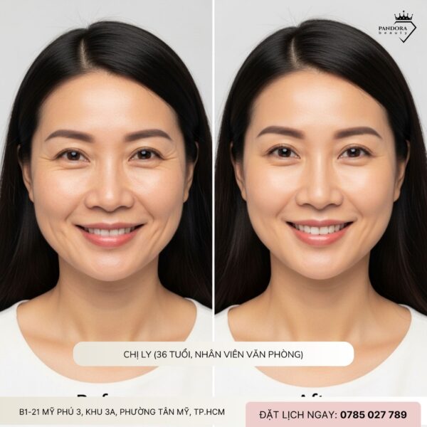 Cảm nhận của khách sau 1 tháng làm nâng cơ HIFU MPT: Bí quyết trẻ hóa an toàn, hiệu quả