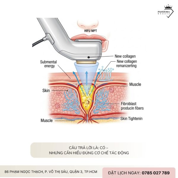 Nâng cơ HIFU MPT có làm giảm nọng cằm không? Câu trả lời khoa học & thực tế dành cho bạn