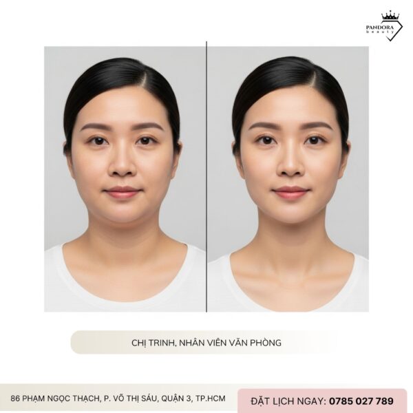 Nâng cơ HIFU MPT có làm giảm nọng cằm không? Câu trả lời khoa học & thực tế dành cho bạn