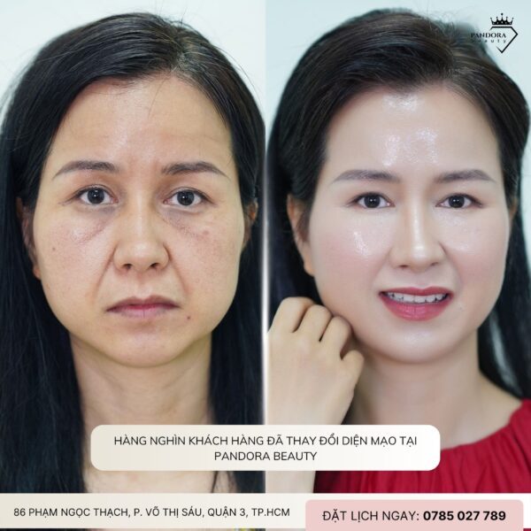 Tại sao nên chọn Nâng cơ HIFU MPT tại Pandora Beauty?
