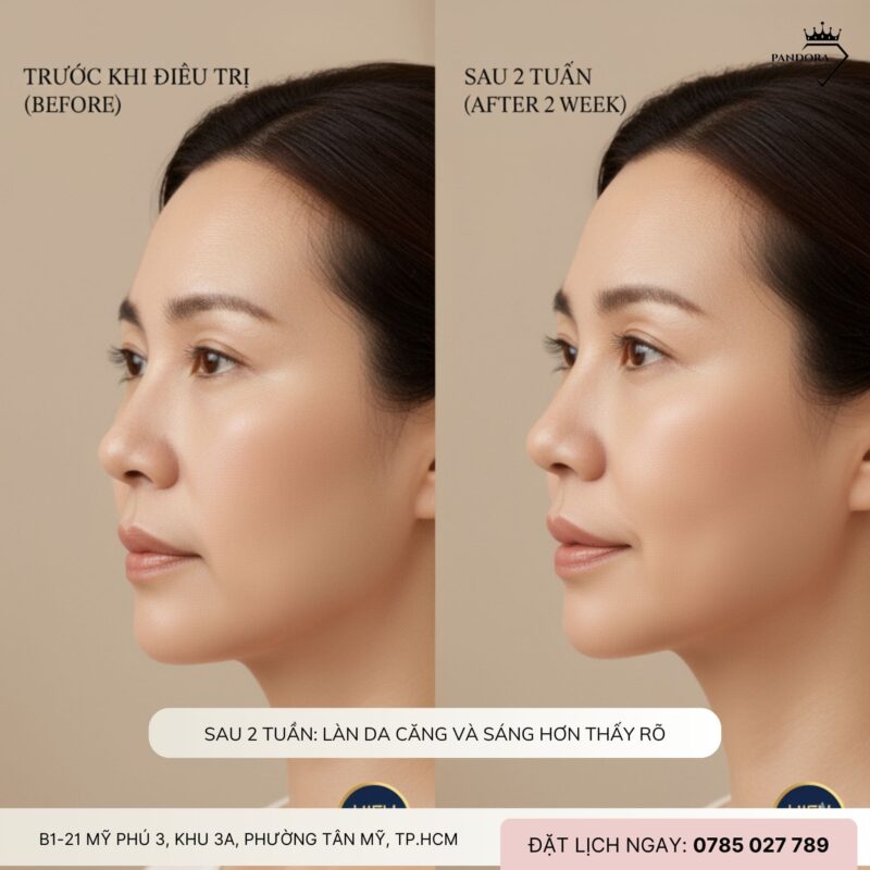 Review trải nghiệm nâng cơ HIFU MPT: 1 tháng sau da thay đổi thế nào?