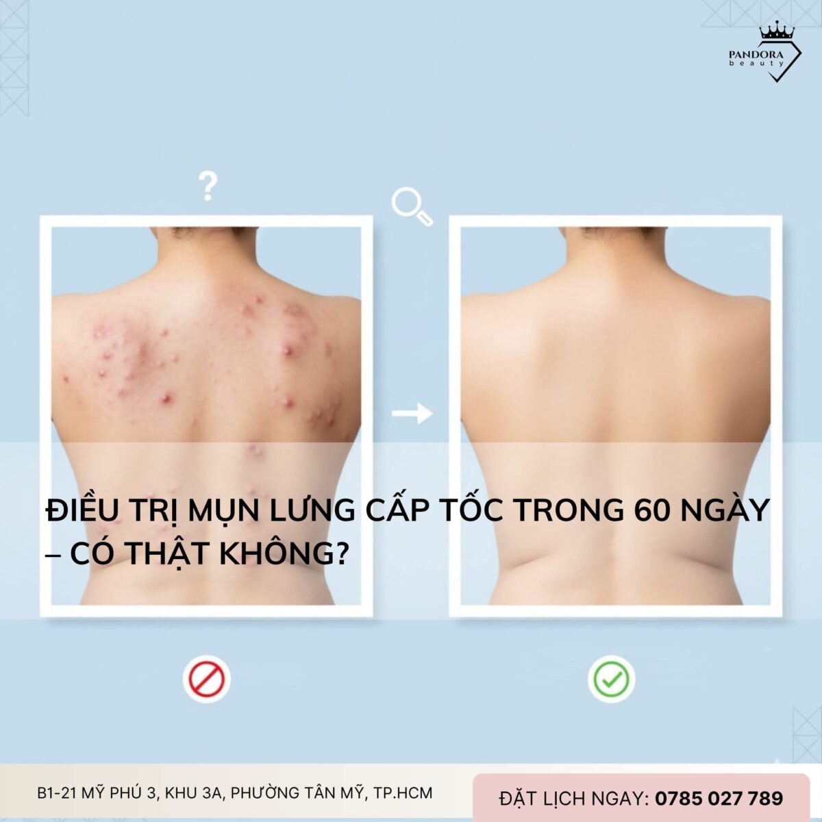 Điều trị mụn lưng cấp tốc trong 60 ngày – Có thật không?