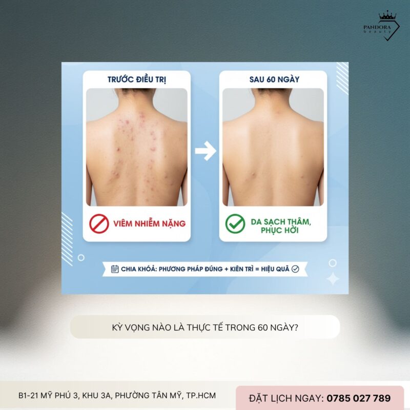 Điều trị mụn lưng cấp tốc trong 60 ngày – Có thật không?
