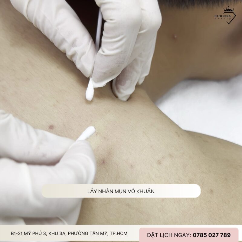Quy trình điều trị mụn lưng tại spa/thẩm mỹ viện như Pandora Beauty: Chuẩn y khoa – Hiệu quả – An toàn