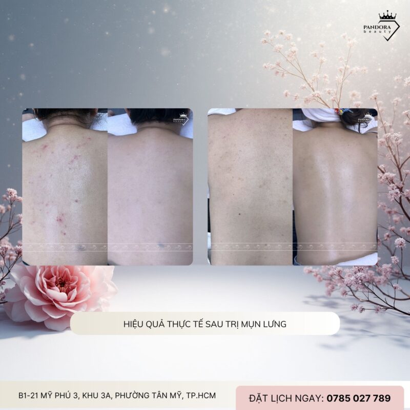 Quy trình điều trị mụn lưng tại spa/thẩm mỹ viện như Pandora Beauty: Chuẩn y khoa – Hiệu quả – An toàn