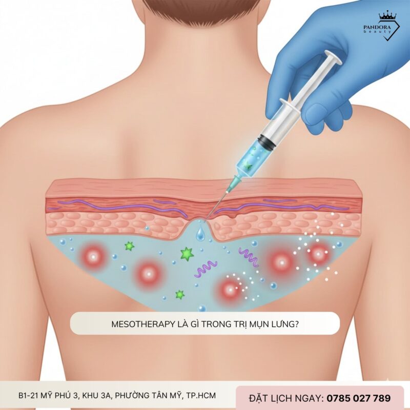 Trị mụn lưng chuyên sâu với Mesotherapy – Giải pháp phục hồi làn da từ gốc