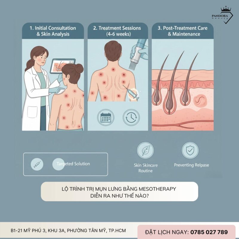Trị mụn lưng chuyên sâu với Mesotherapy – Giải pháp phục hồi làn da từ gốc