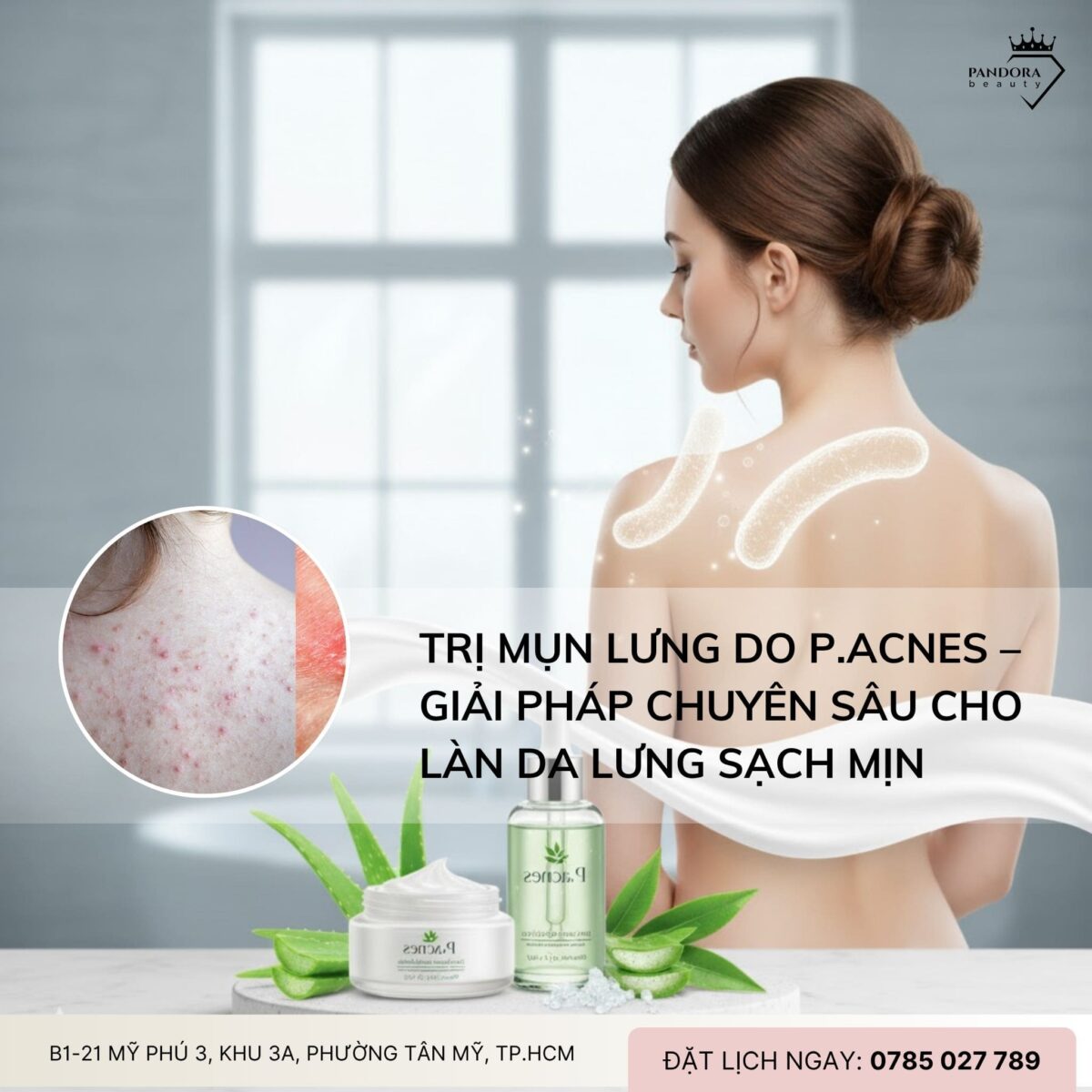 Trị mụn lưng do P.acnes – Giải pháp chuyên sâu cho làn da lưng sạch mịn