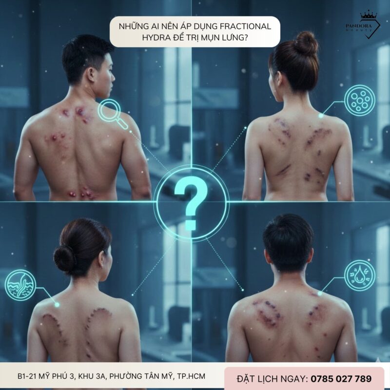 Trị mụn lưng toàn diện với công nghệ Fractional Hydra – Giải pháp cải thiện sẹo lưng sau mụn hiện đại