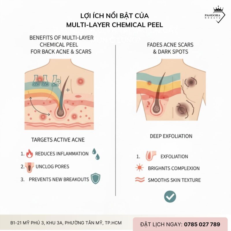 Trị mụn lưng với Multi-layer Chemical Peel – Giải pháp triệt thâm, sáng vùng lưng