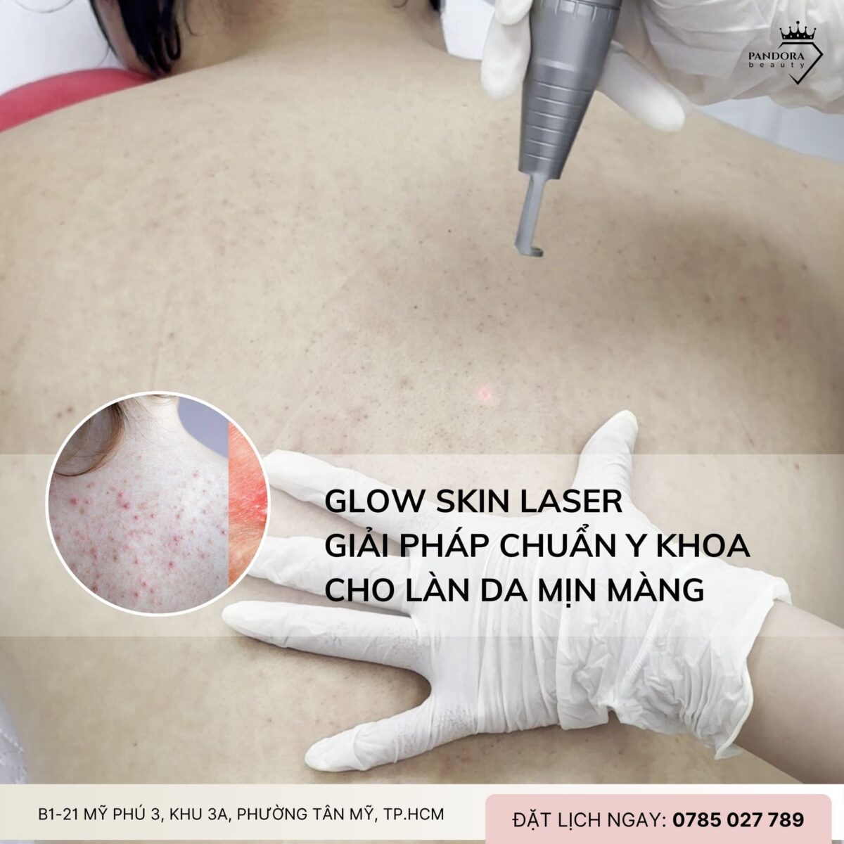 Điều trị mụn lưng với Glow Skin Laser: Giải pháp chuẩn y khoa cho làn da mịn màng