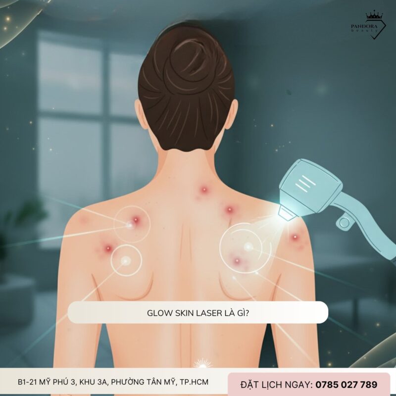 Điều trị mụn lưng với Glow Skin Laser: Giải pháp chuẩn y khoa cho làn da mịn màng