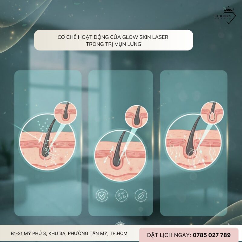 Điều trị mụn lưng với Glow Skin Laser: Giải pháp chuẩn y khoa cho làn da mịn màng