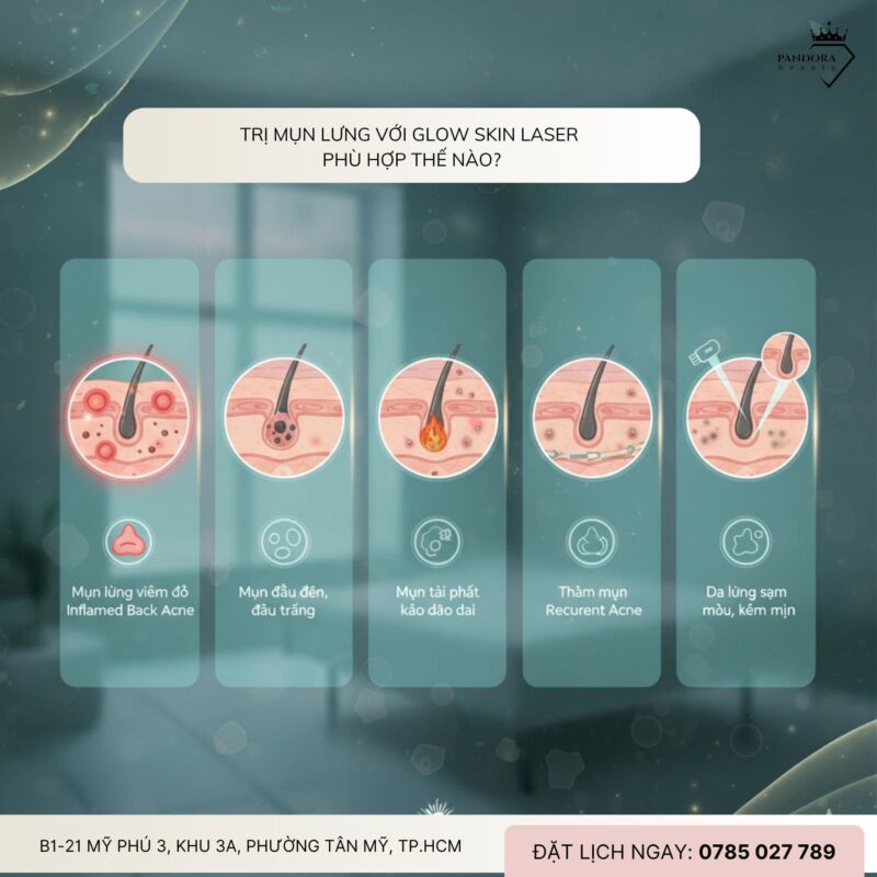 Điều trị mụn lưng với Glow Skin Laser: Giải pháp chuẩn y khoa cho làn da mịn màng