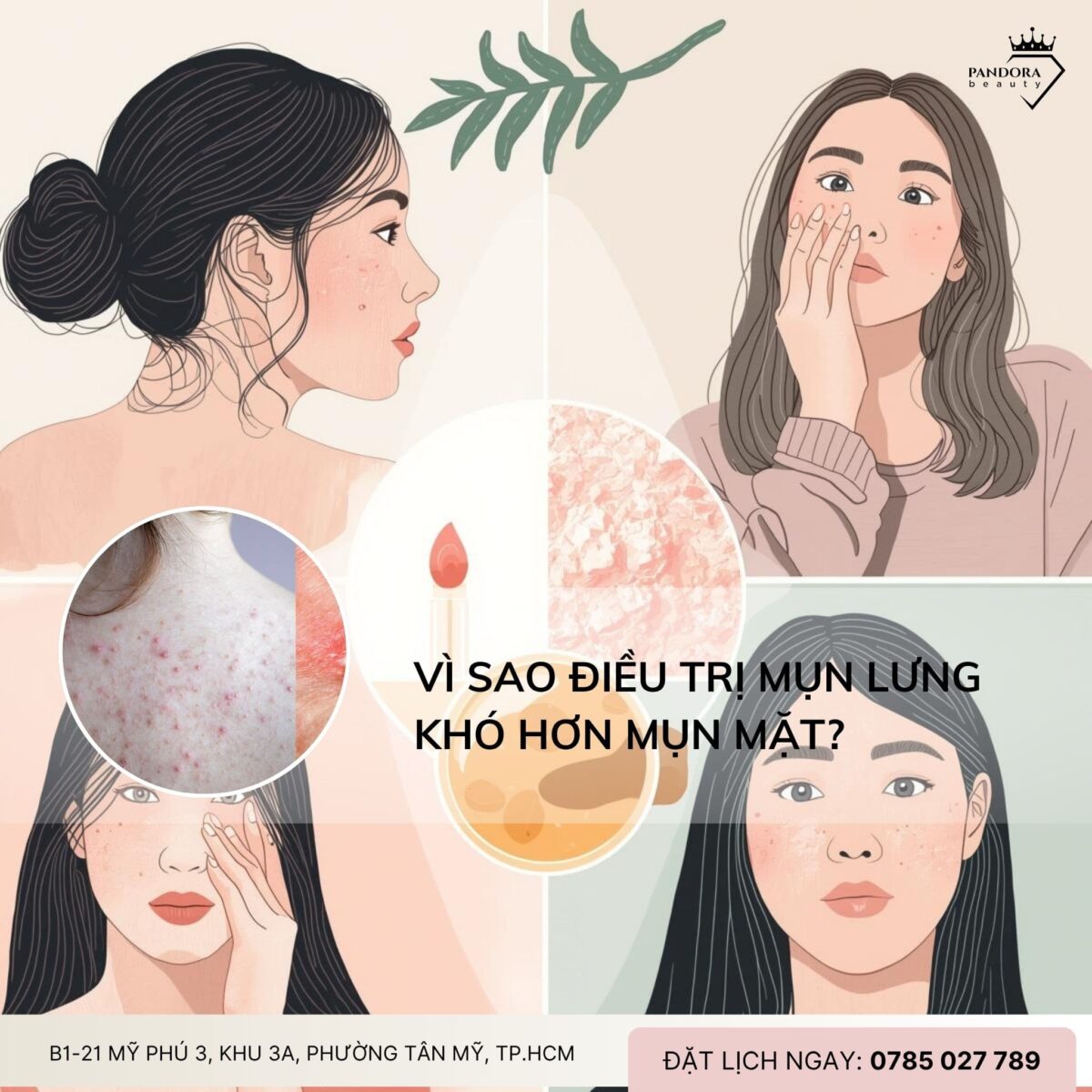 Vì sao điều trị mụn lưng khó hơn mụn mặt?
