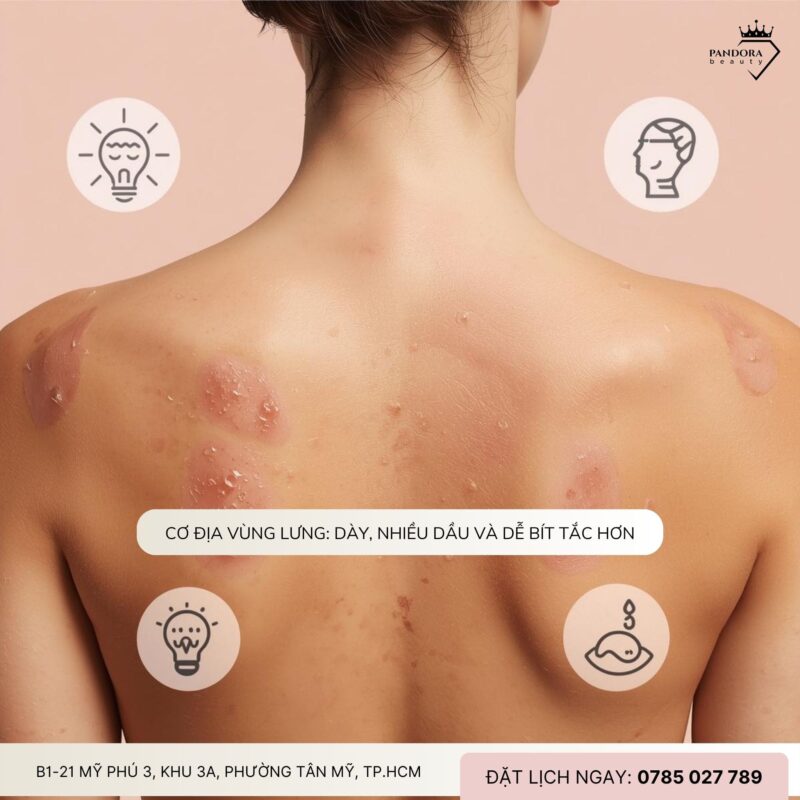 Vì sao điều trị mụn lưng khó hơn mụn mặt?