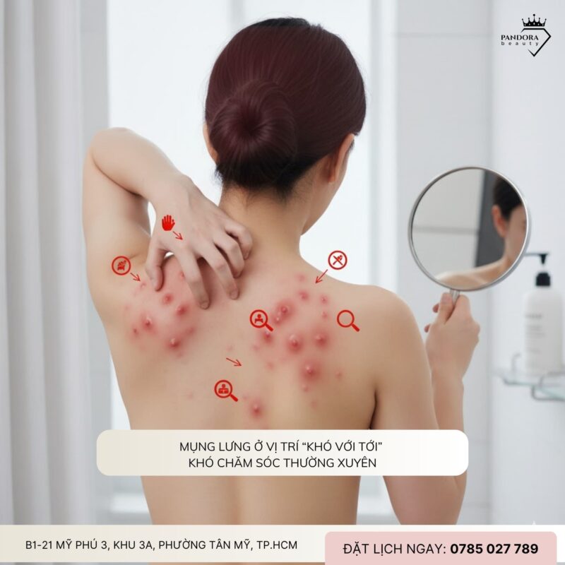 Vì sao điều trị mụn lưng khó hơn mụn mặt?