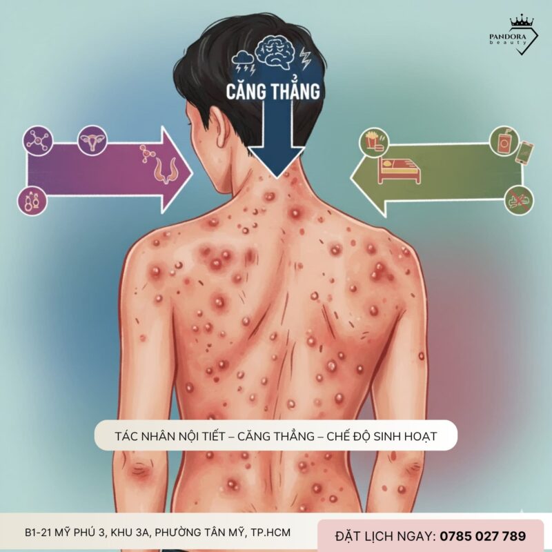 Vì sao điều trị mụn lưng khó hơn mụn mặt?