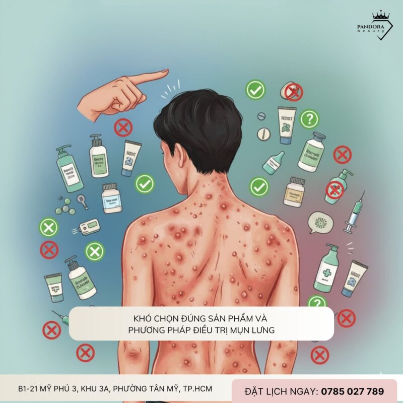 Vì sao điều trị mụn lưng khó hơn mụn mặt?