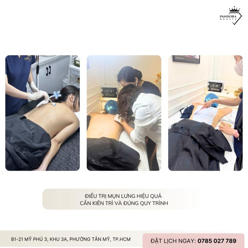 Vì sao điều trị mụn lưng khó hơn mụn mặt?