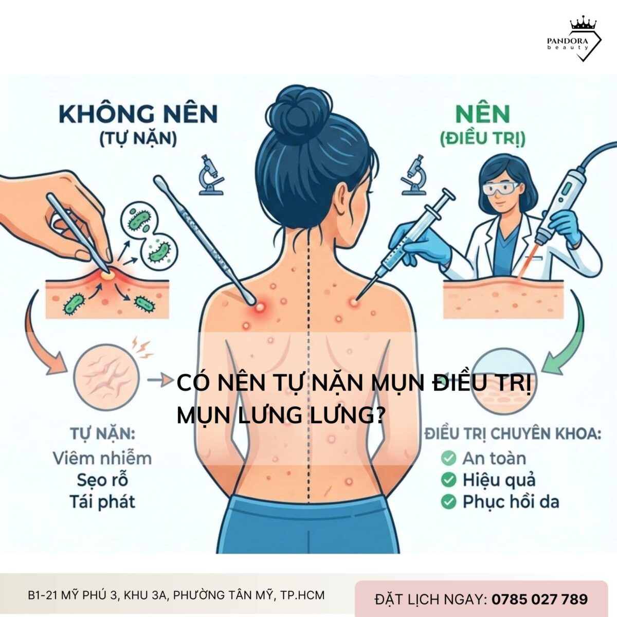 Có nên tự nặn mụn điều trị mụn lưng lưng?