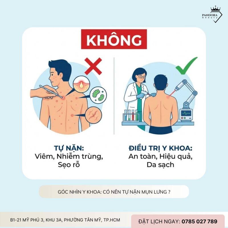 Có nên tự nặn mụn điều trị mụn lưng lưng?