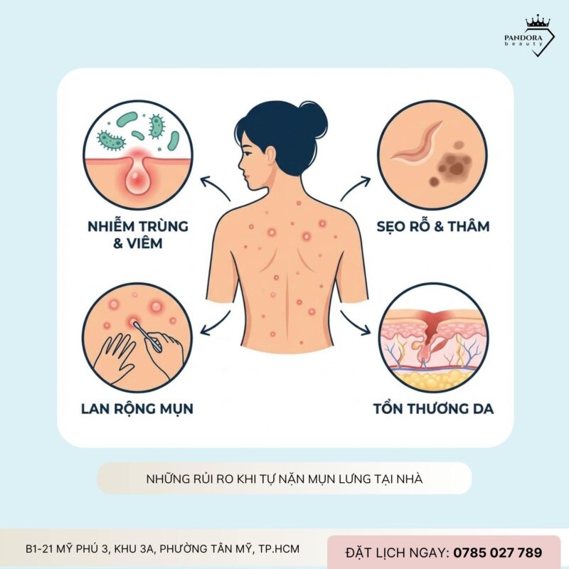 Có nên tự nặn mụn điều trị mụn lưng lưng?