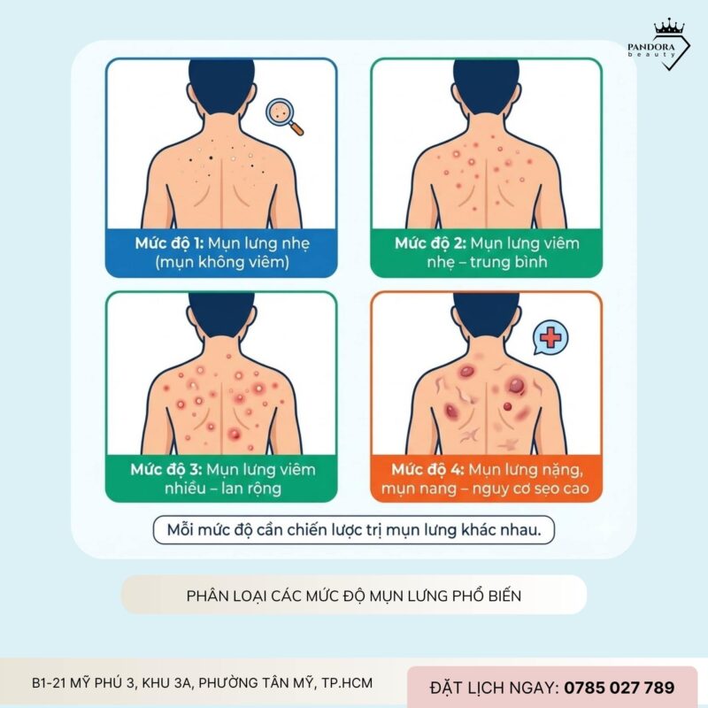 Điều trị mụn lưng theo từng mức độ: Hiểu đúng để trị mụn lưng hiệu quả và bền vững