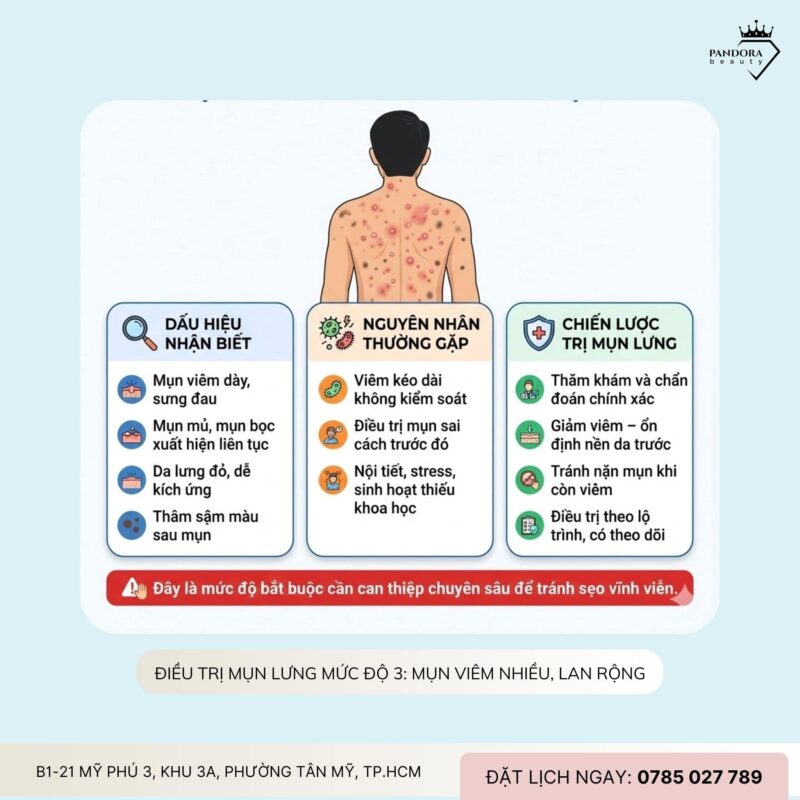 Điều trị mụn lưng theo từng mức độ: Hiểu đúng để trị mụn lưng hiệu quả và bền vững