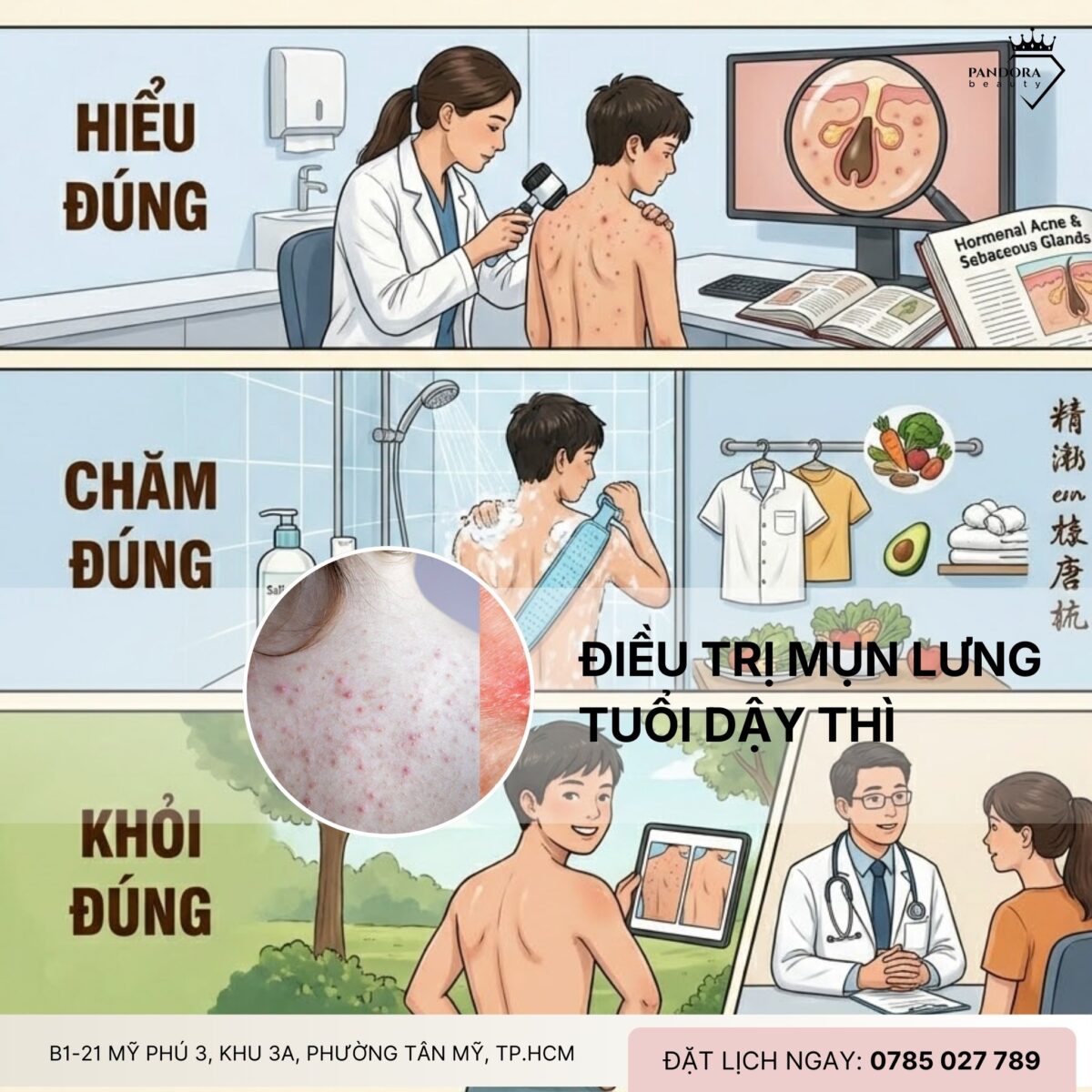 Điều trị mụn lưng tuổi dậy thì: Hiểu đúng – Chăm đúng – Khỏi đúng
